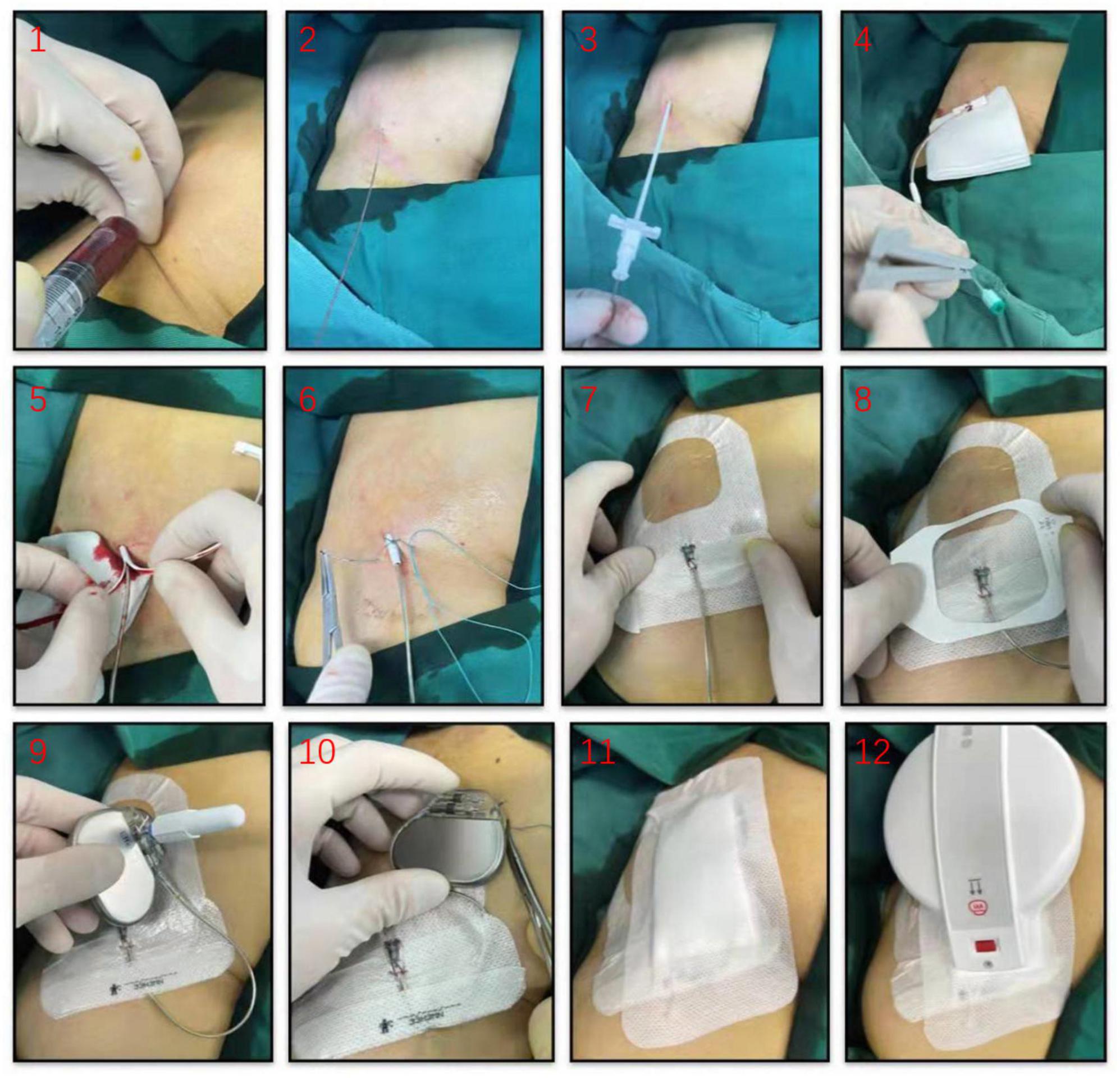 Feasibility study of temporary permanent pacemaker in patients with conduction block after TAVR